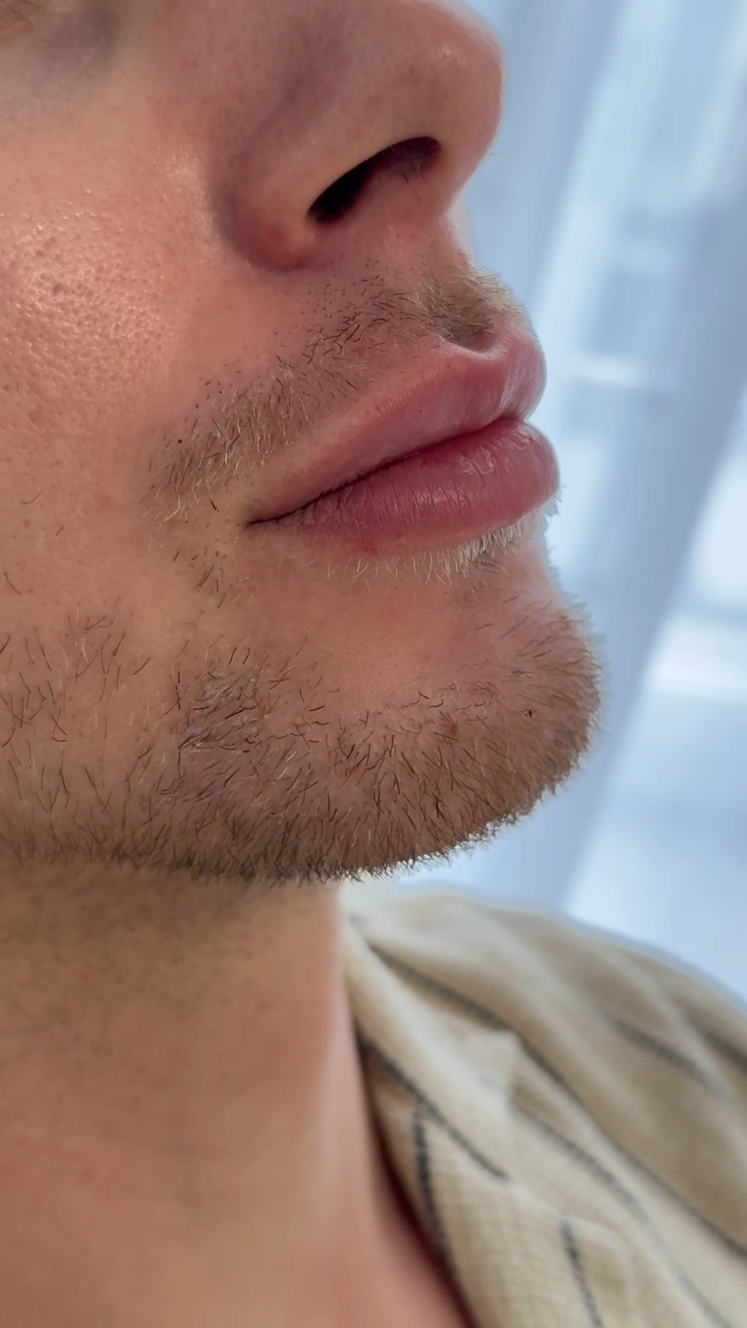 Läppfiller-resultat hos dR Kliniken