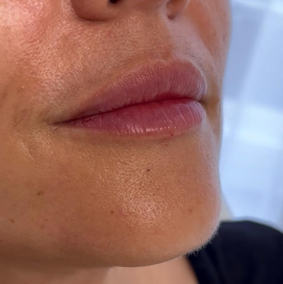 Läppfiller-resultat hos dR Kliniken